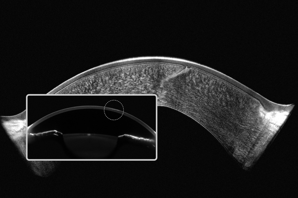 Scheimpflug OCT Image