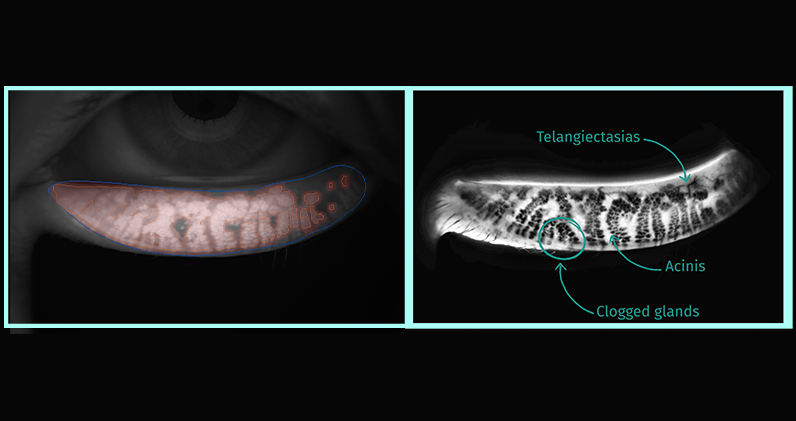 Eyelid everter of C.Diag®