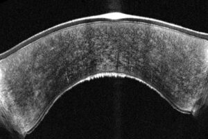 Early fuchs dystrophy