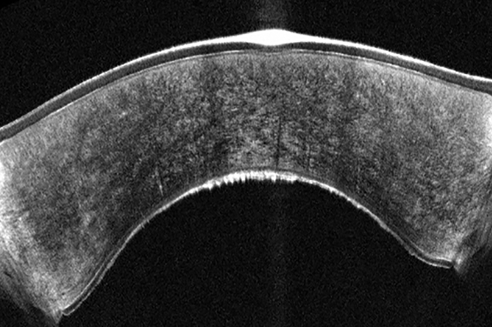 Early fuchs dystrophy