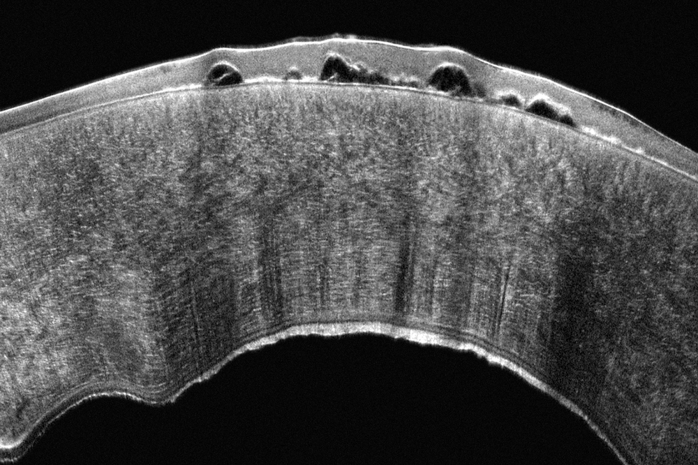 Bullous keratopathy in fuchs dystrophy