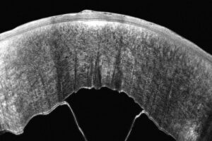 Endothelial detachment